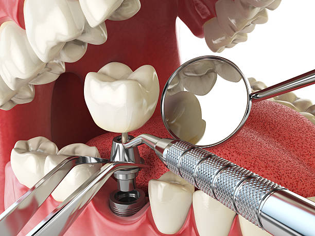 Best Emergency Dental Care for Broken or Chipped Teeth in South San Gabriel, CA